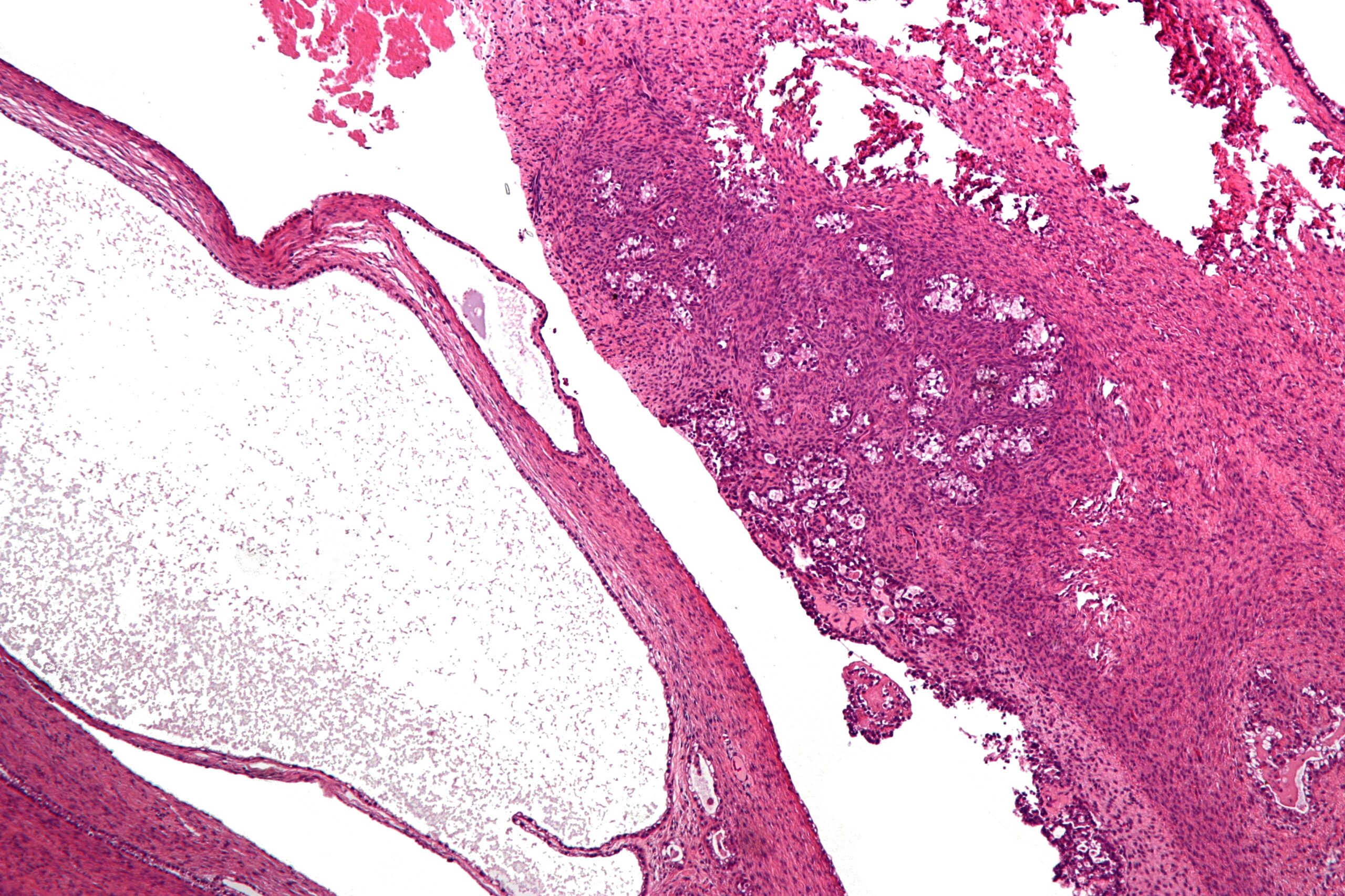 Low-magnification micrograph of ovarian cancer cells. Ovarian cancer is particularly common among Ashkenazi Jews. (Photo/Wikimedia-Nephron CC BY-SA 3.0)